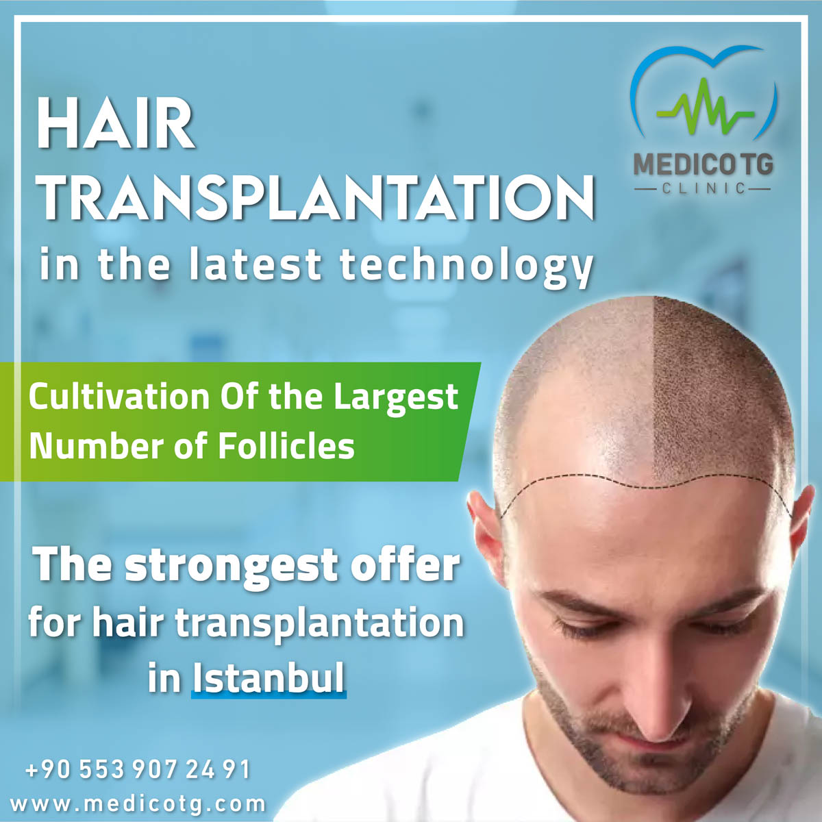 hair transplantation-01